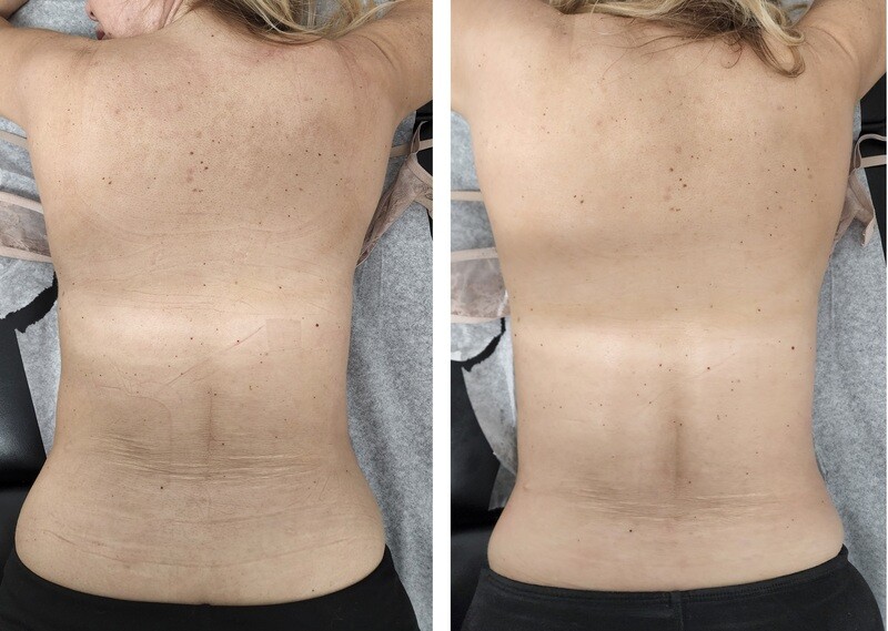 NUERA TIGHT BACK TREATMENT