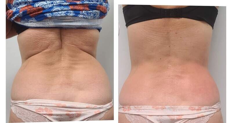 NUERA TIGHT BACK TREATMENT