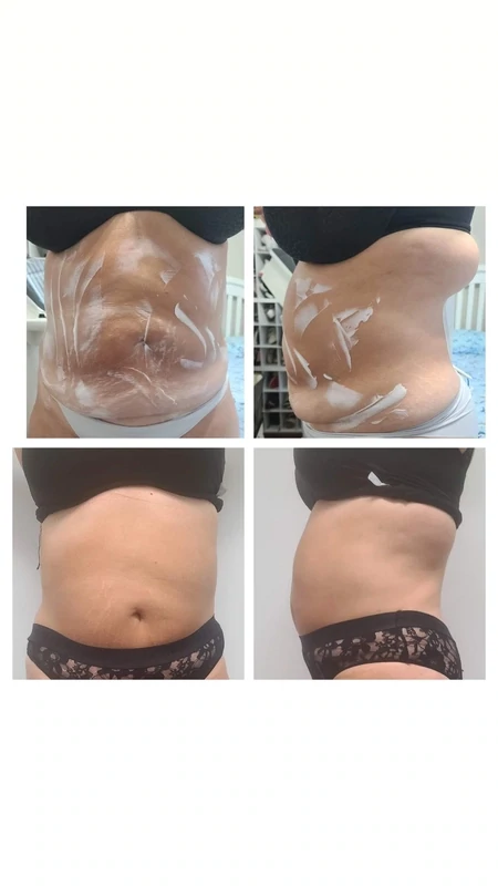 NUERA TIGHT BELLY TREATMENT
