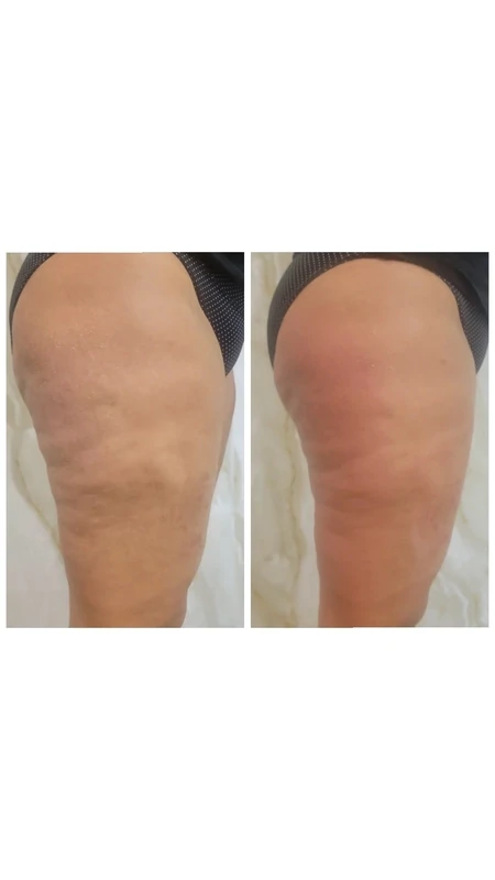 NUERA TIGHT LEG TREATMENT