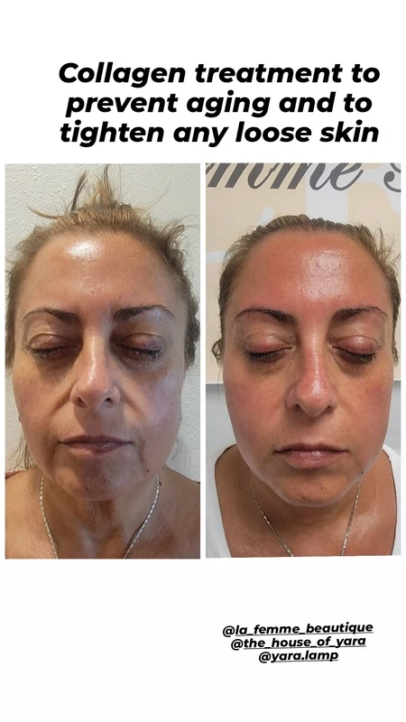 NUERA TIGHT FACE TREATMENT