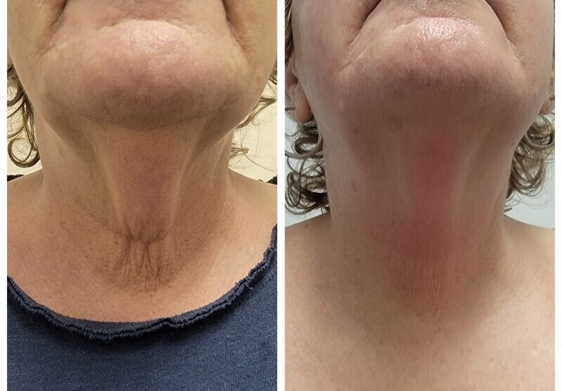 NUERA TIGHT NECK TREATMENT
