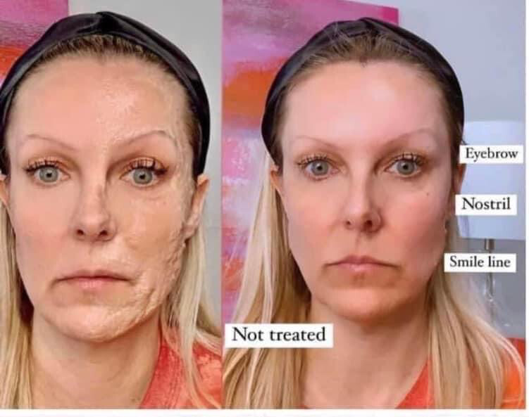 Botox In A Bottle Kit