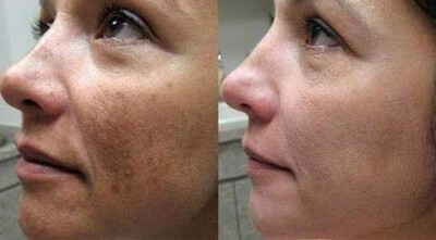 Facial Peel