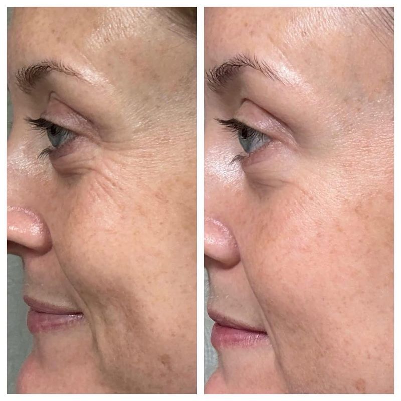 Microneedling &amp; Red Light Therapy