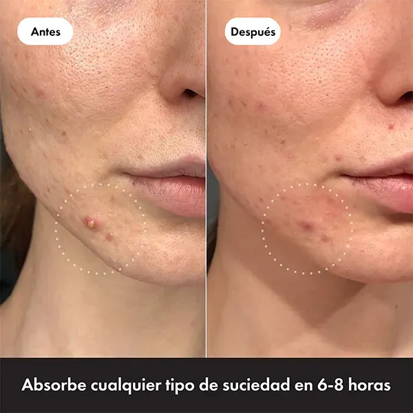 Mighty Patch The Original Parches para Acne Hero 24u