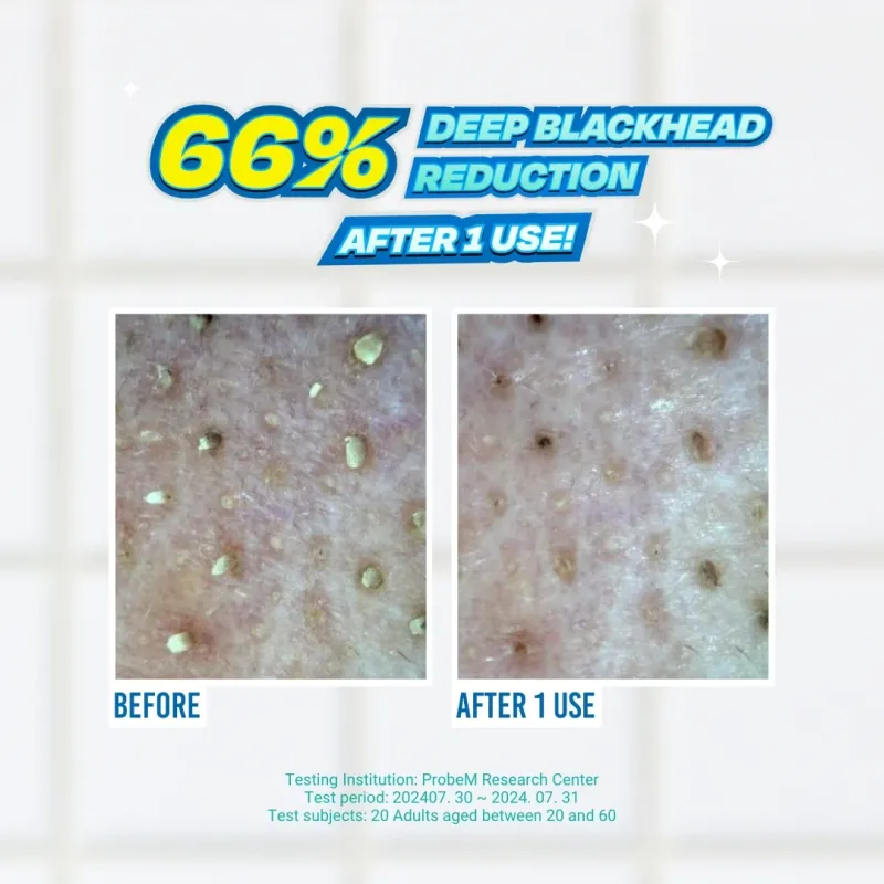 JUMISO - Blackhead Melting Softener