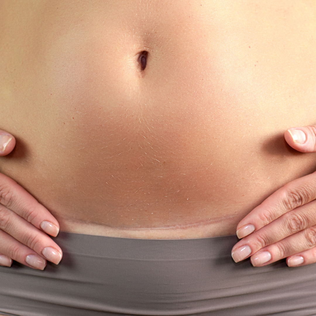 Desvanecimiento de cicatrices por cesárea o abdominoplastía