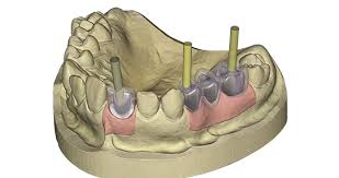 Exocad Add-On (Licence Flex) Module Implant