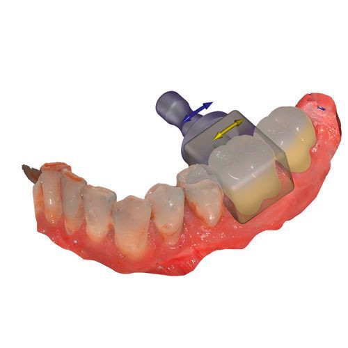 Exocad Add-On (Licence Flex) Module In-Cad Nesting