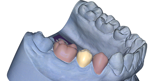 Exocad Add-On (Licence Flex) Module Provisional