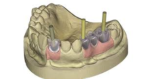 Exocad Add-On (Licence Flex) Module Implant Exocad Add-On (Licence Flex) Module Implant