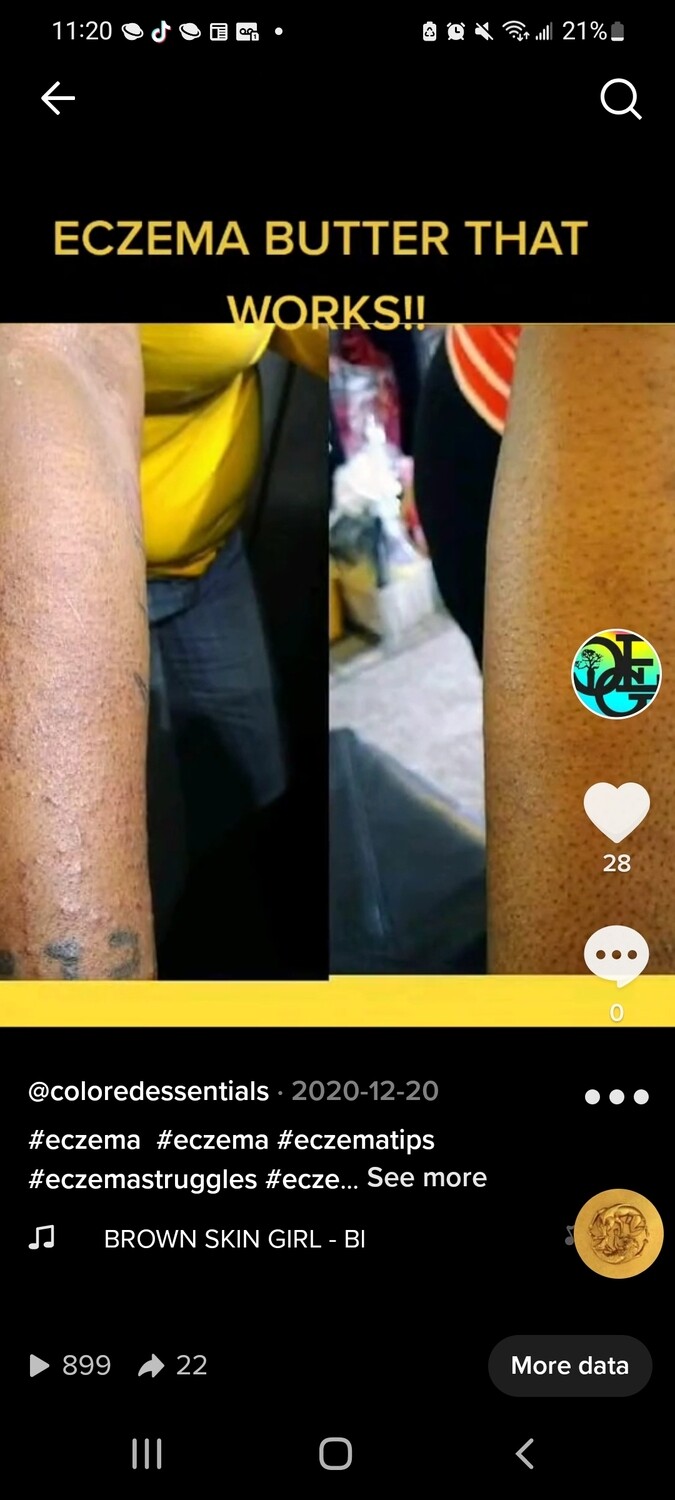 Eczema Cream 8 oz