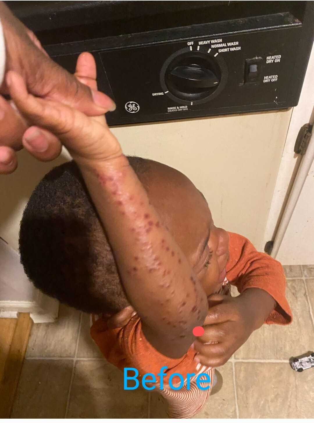 Eczema Therapy Bar