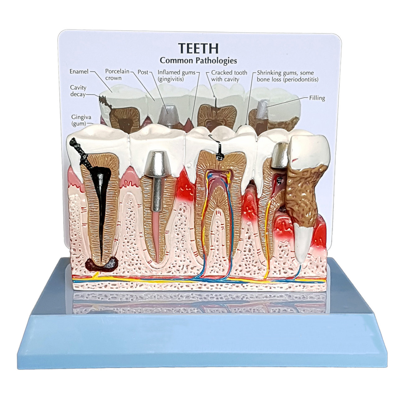 Anatomical Human Pathological Teeth and Gums Model
