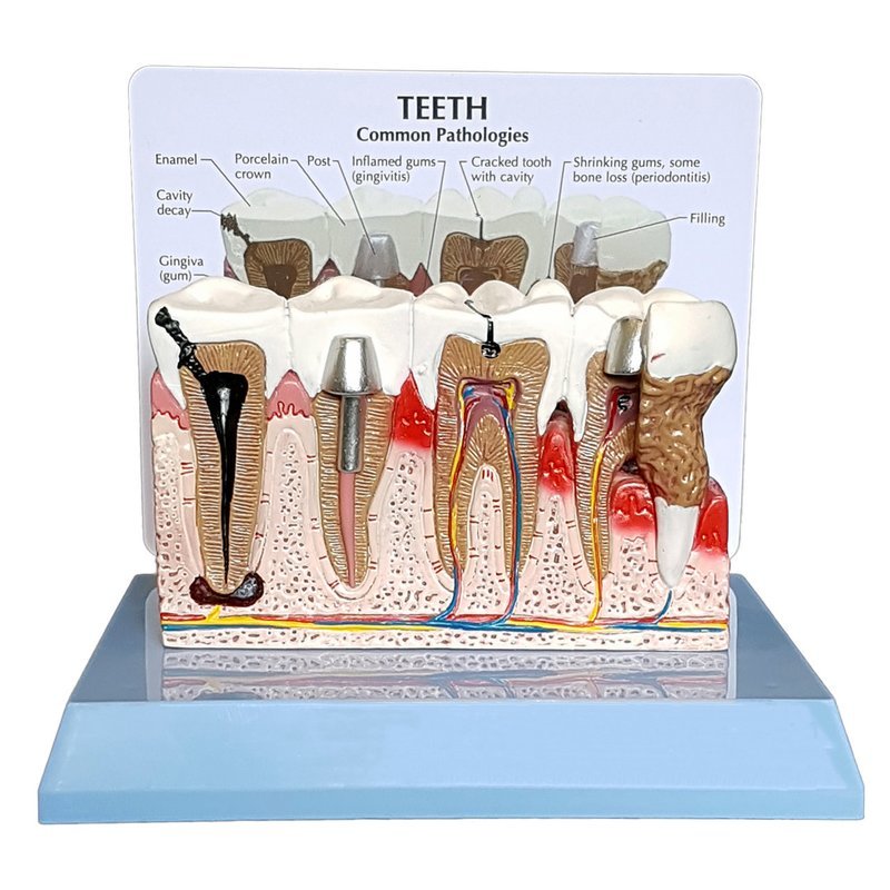 Anatomical Human Pathological Teeth and Gums Model