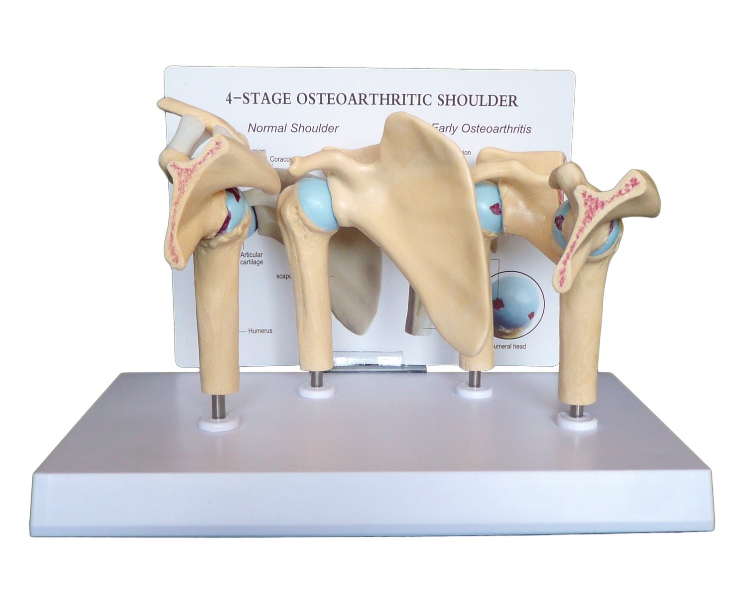 Anatomical Human Shoulder 4-Stage Osteoarthritic Glenohumeral Joint Model