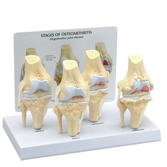 Anatomical Human Degenerative Knee Joint Disease Model
