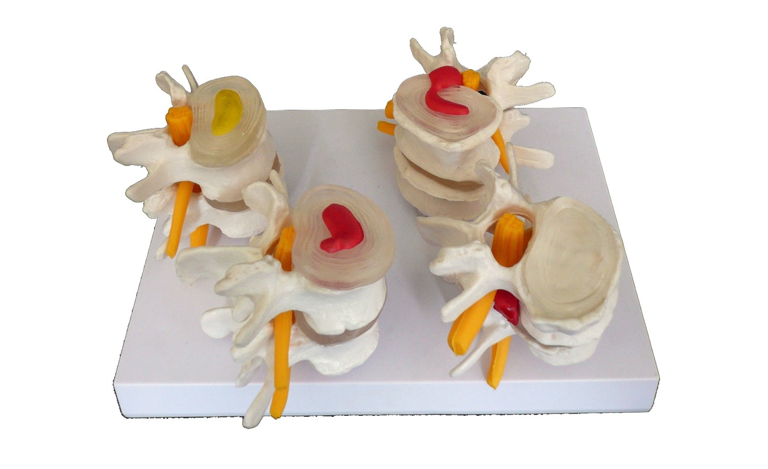 Anatomical Human Lumbar Vertebrae Degenerative Disc Disease Model