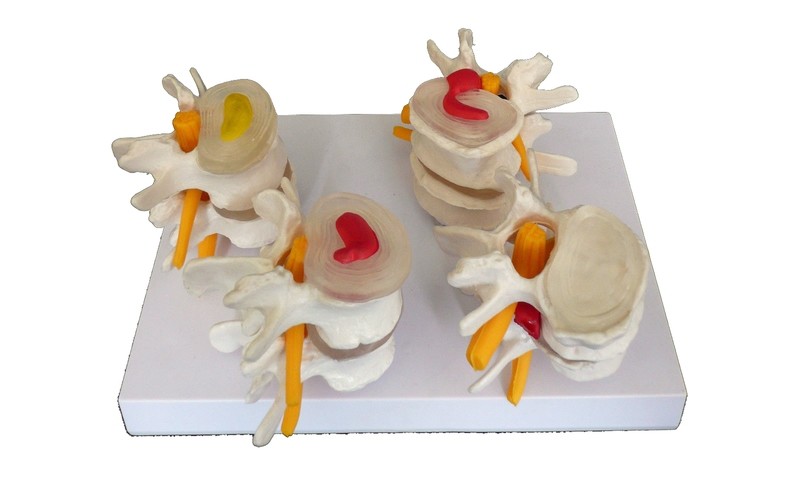 Anatomical Human Lumbar Vertebrae Degenerative Disc Disease Model