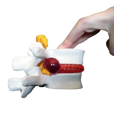 Anatomical Human Herniated Lumbar Vertebrae Disc Prolapse Model