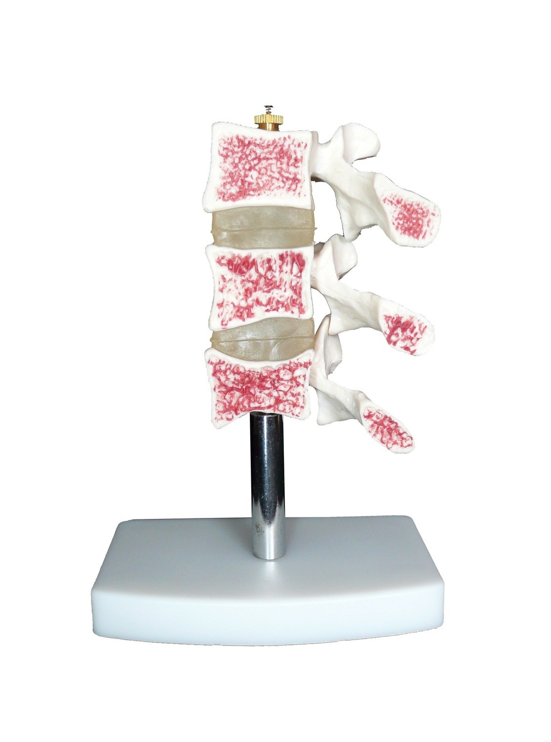 Anatomical Human Osteoporosis Vertebrae Model