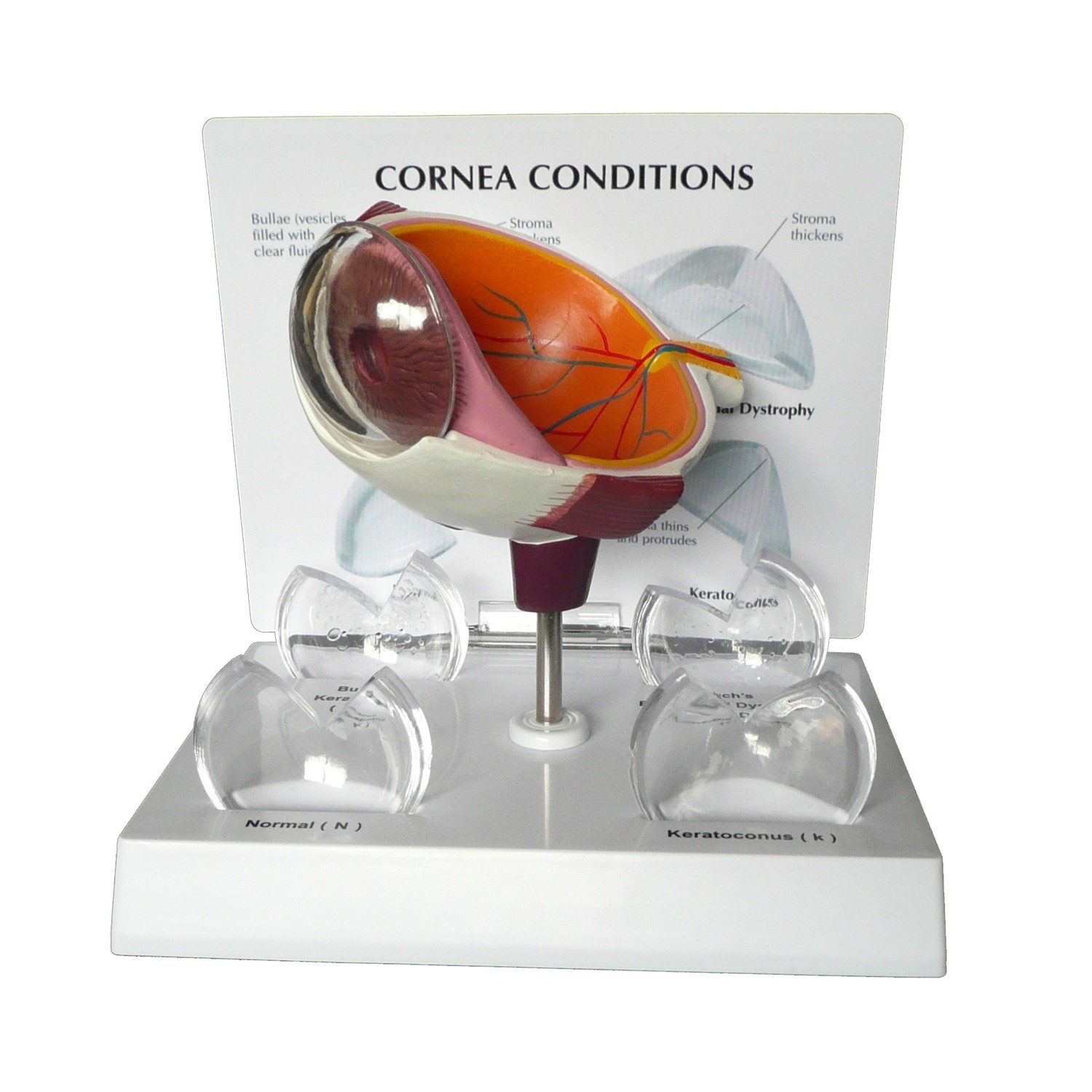 Anatomical Human Cornea Disease Eye Model