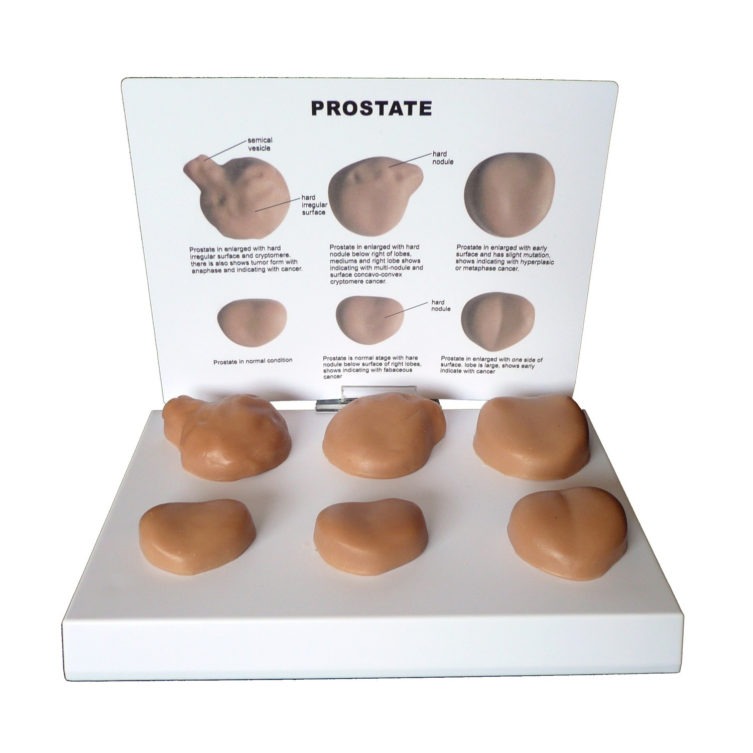 Anatomical Human Male Pathological Prostate Disease Model