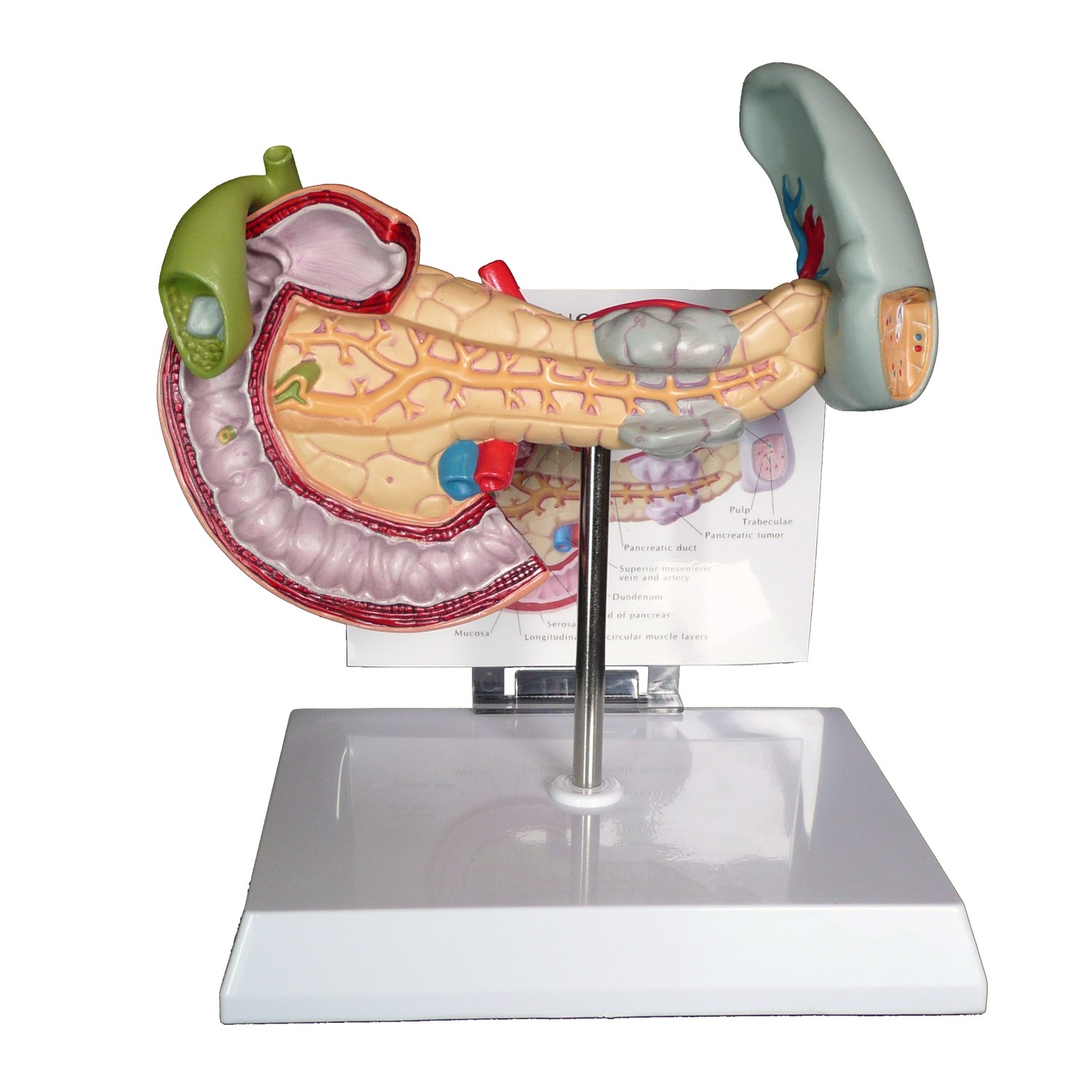 Anatomical Human Pancreas, Spleen and Gallbladder Pathological Diseases Model
