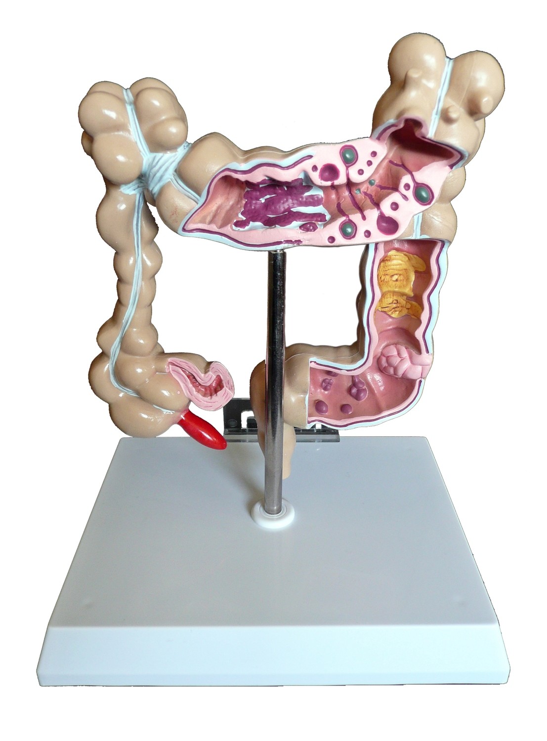 Anatomical Human Colon Pathological Diseases Model