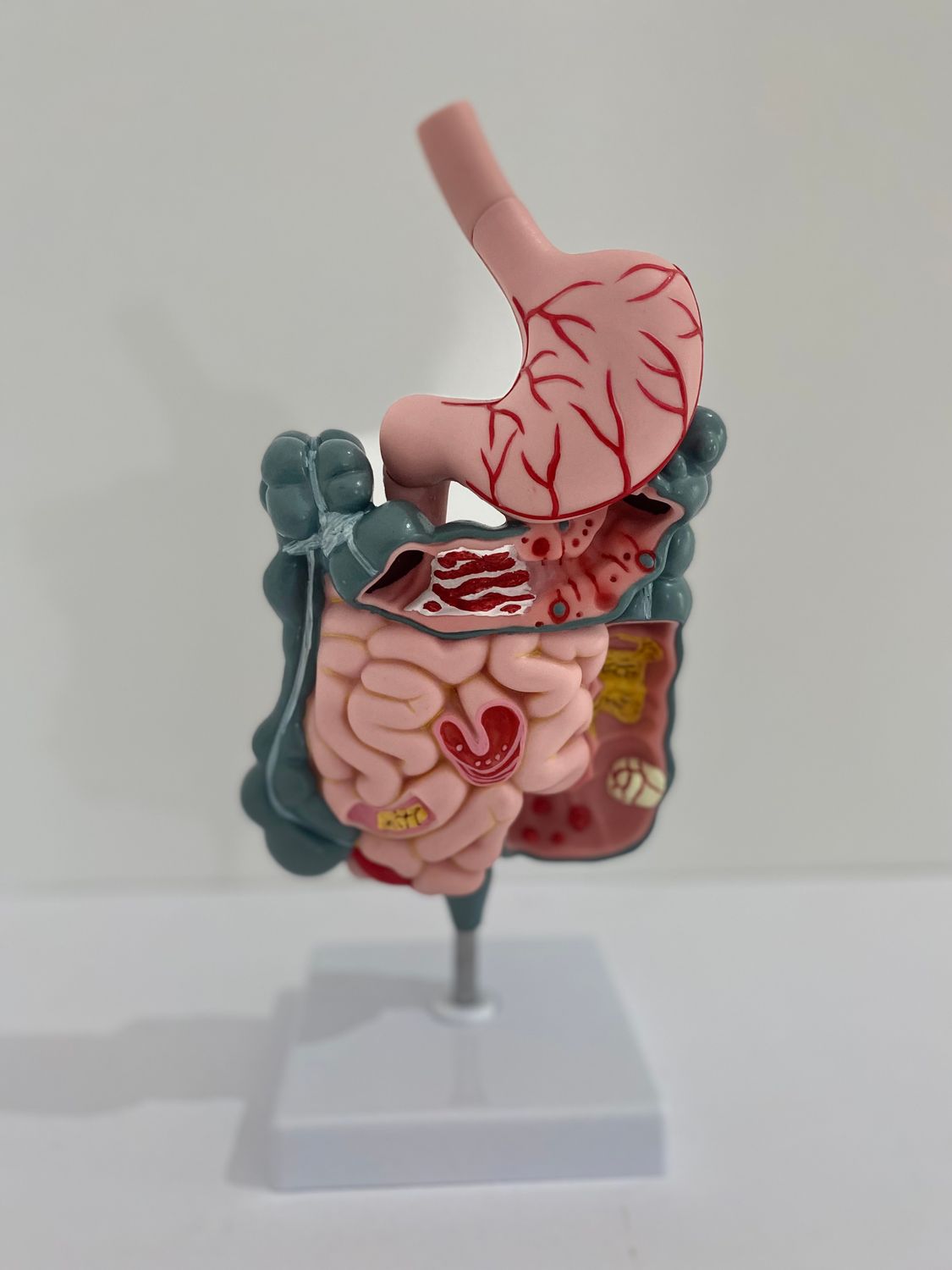 Anatomical Human Diseased Digestive System