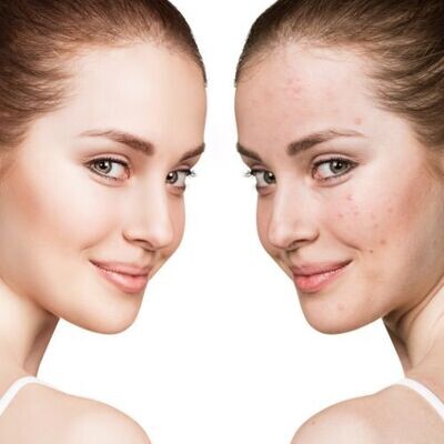 Purification Acne Facial