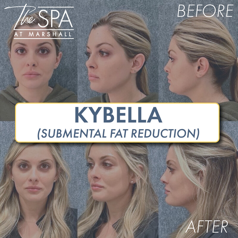 Kybella