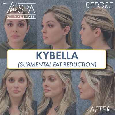 Kybella