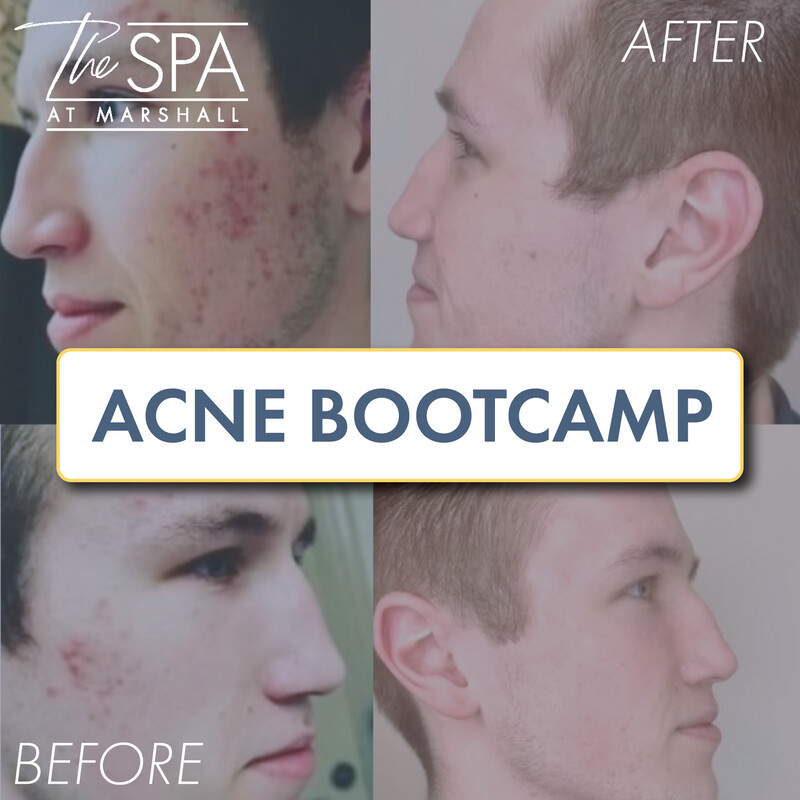 Acne Bootcamp