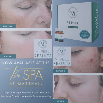 VI Peel