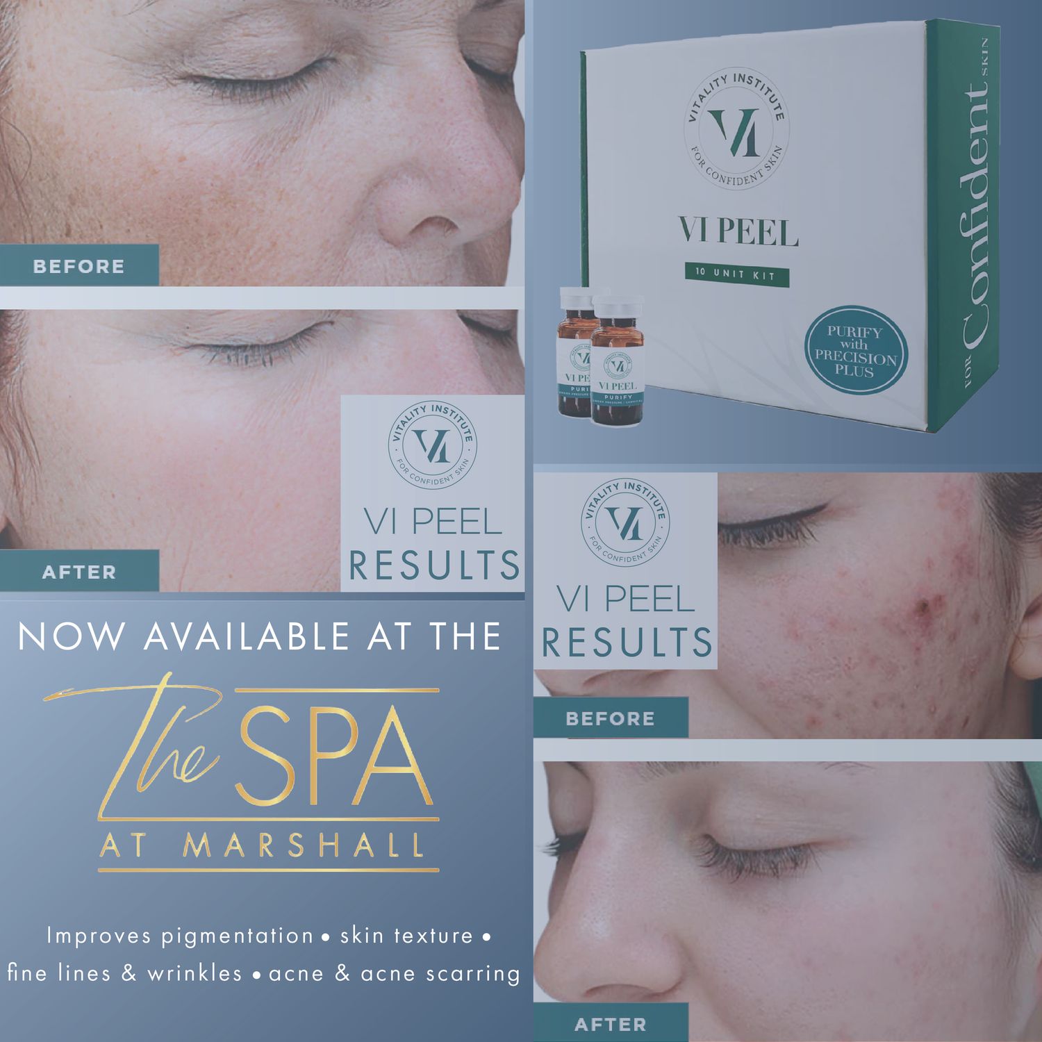 VI Peel (Package of 4)