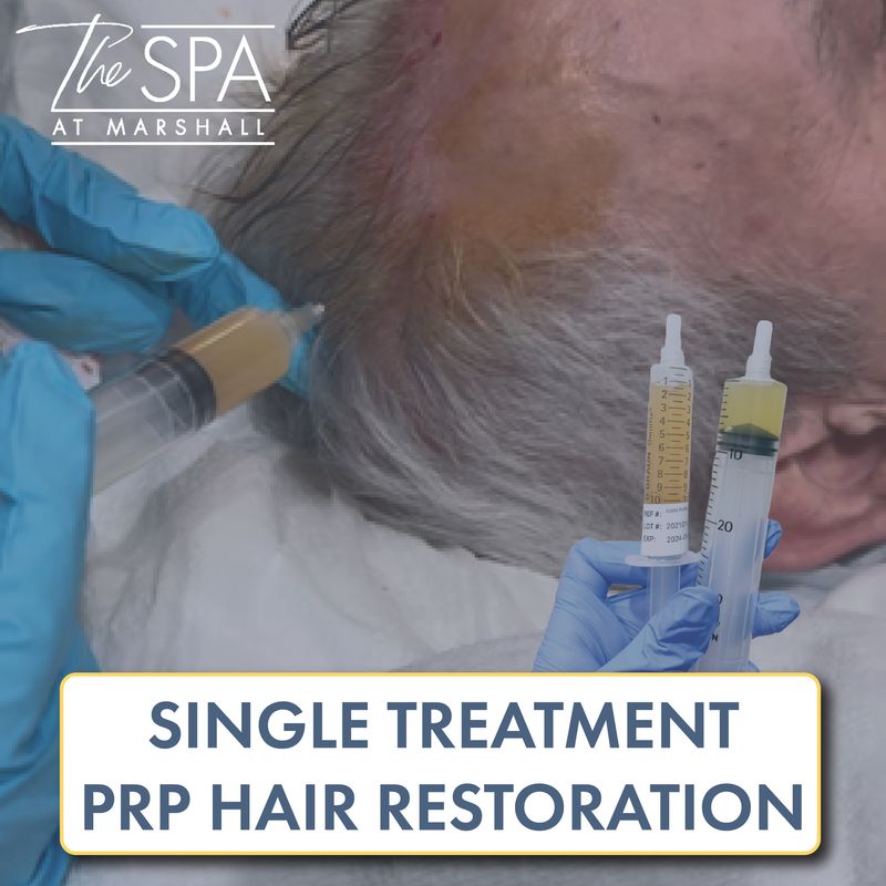 PRP Hair Restoration - Single Treatment