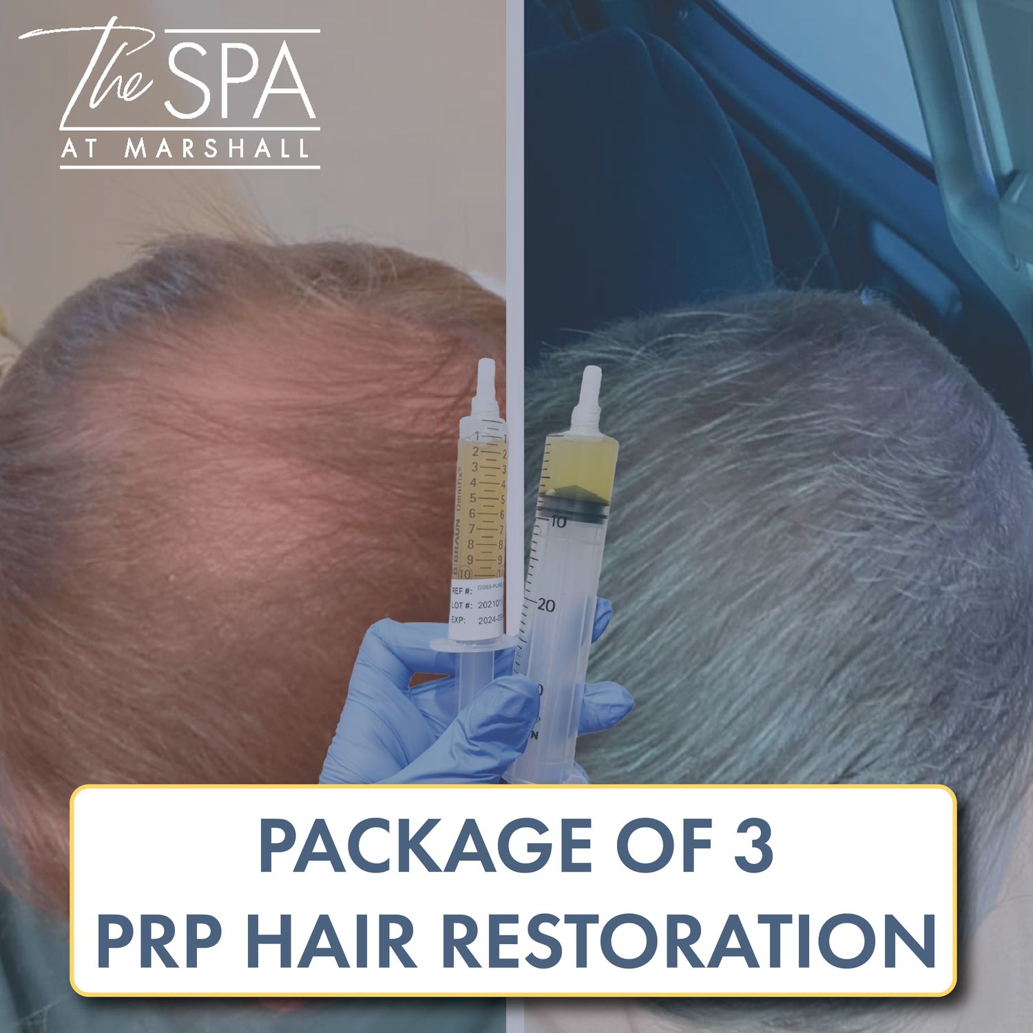 PRP Hair Restoration - Package of 3