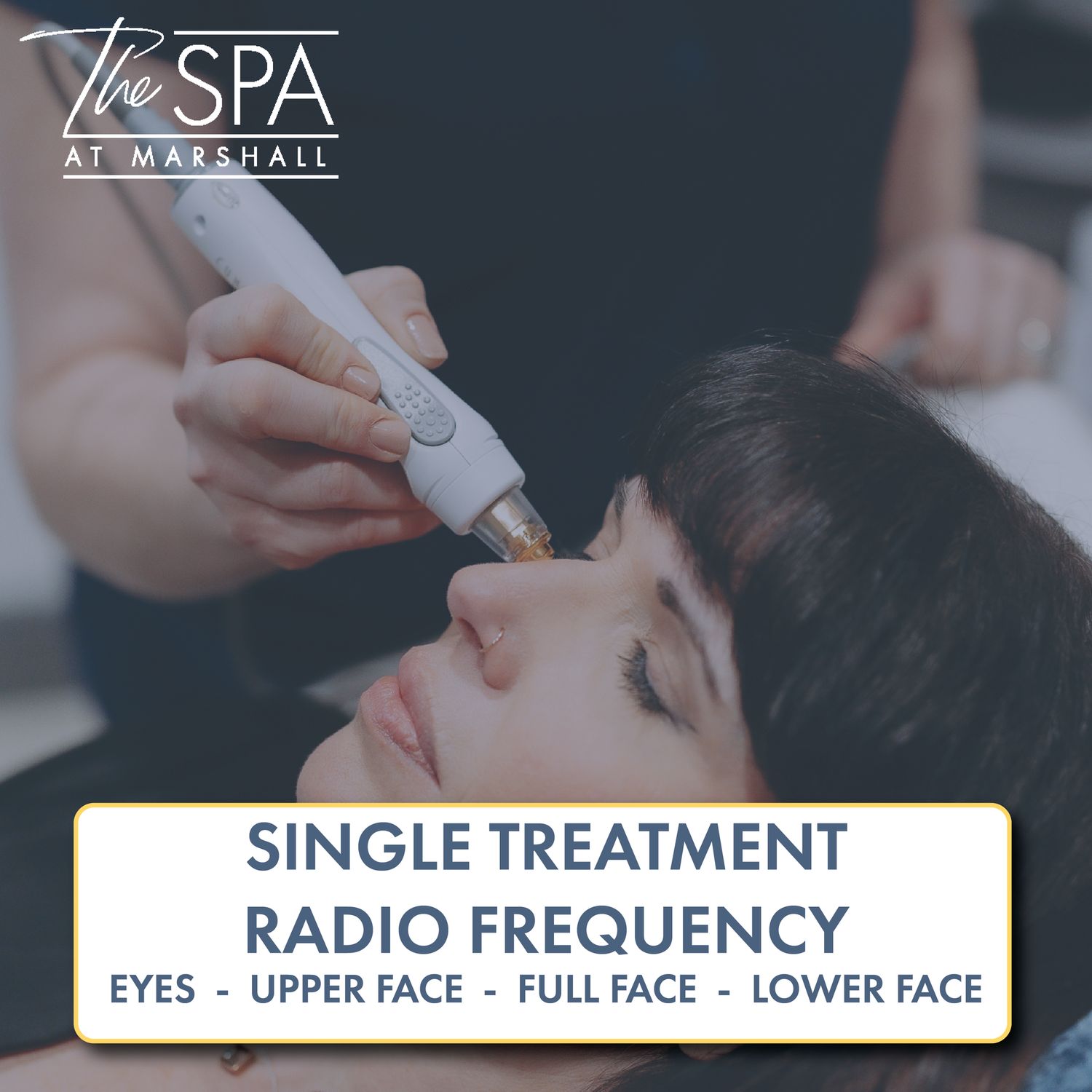 Radio Frequency: Single Treatments