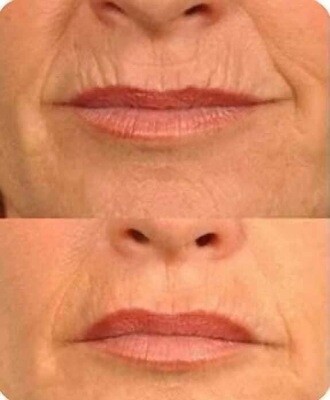 Lines and Wrinkles