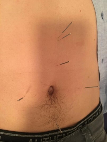 Abdominal Acupuncture One Day Workshop