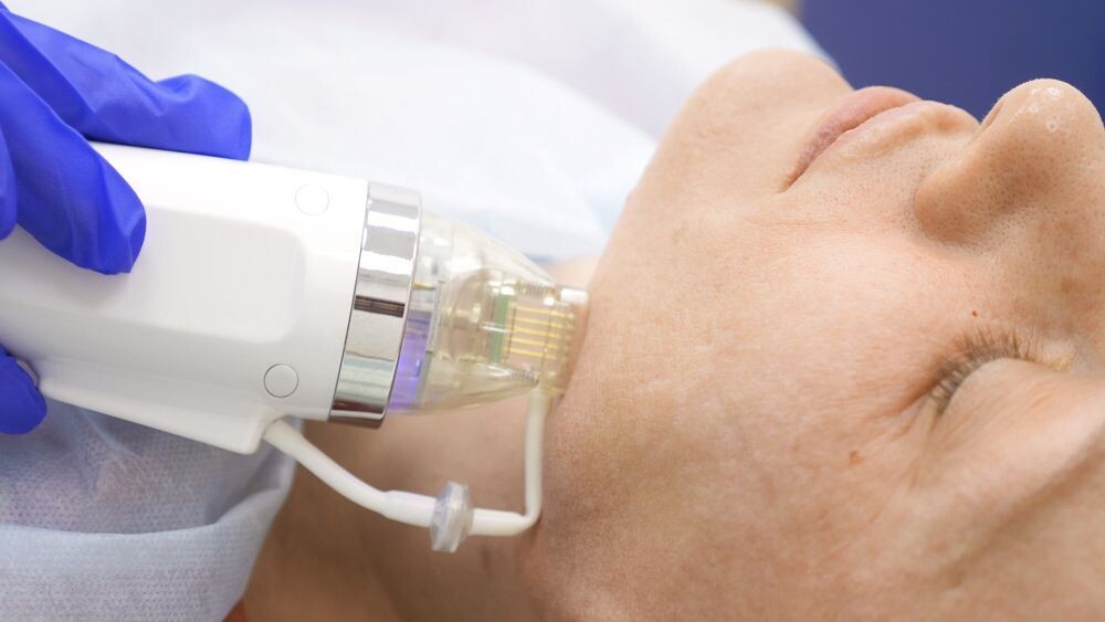 Morpheus8 Microneedling And RF Full Face