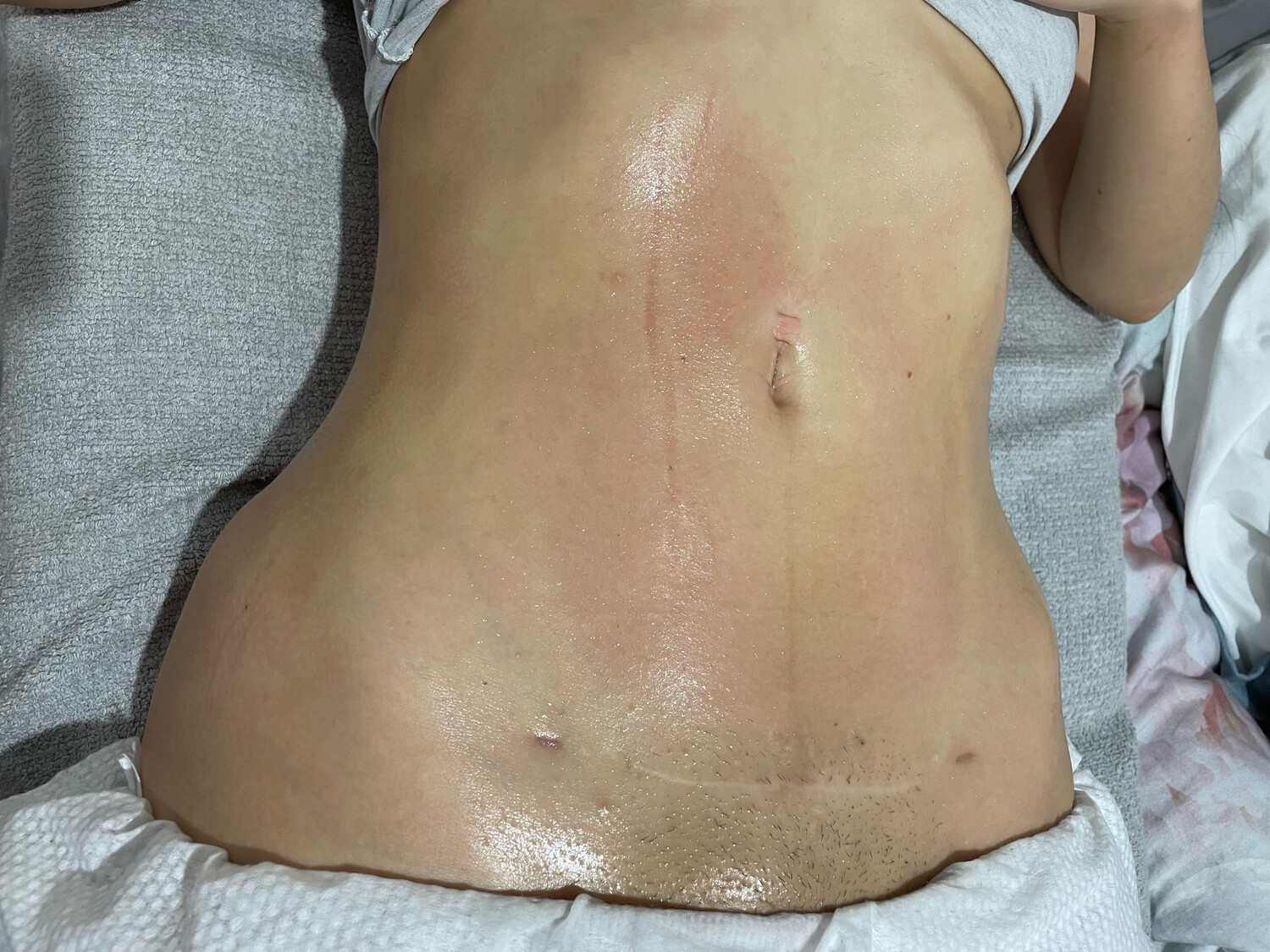 Postoperative lymphatic drainage