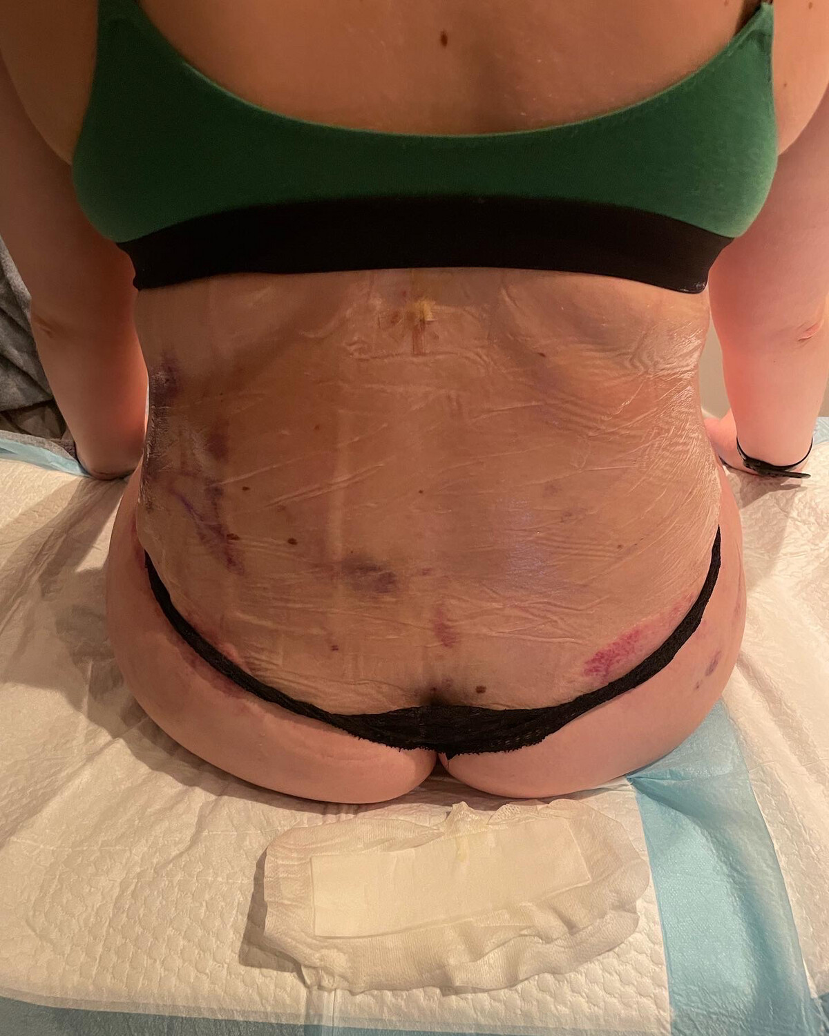 Postoperative lymphatic drainage