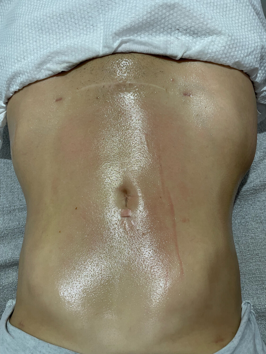 Postoperative lymphatic drainage