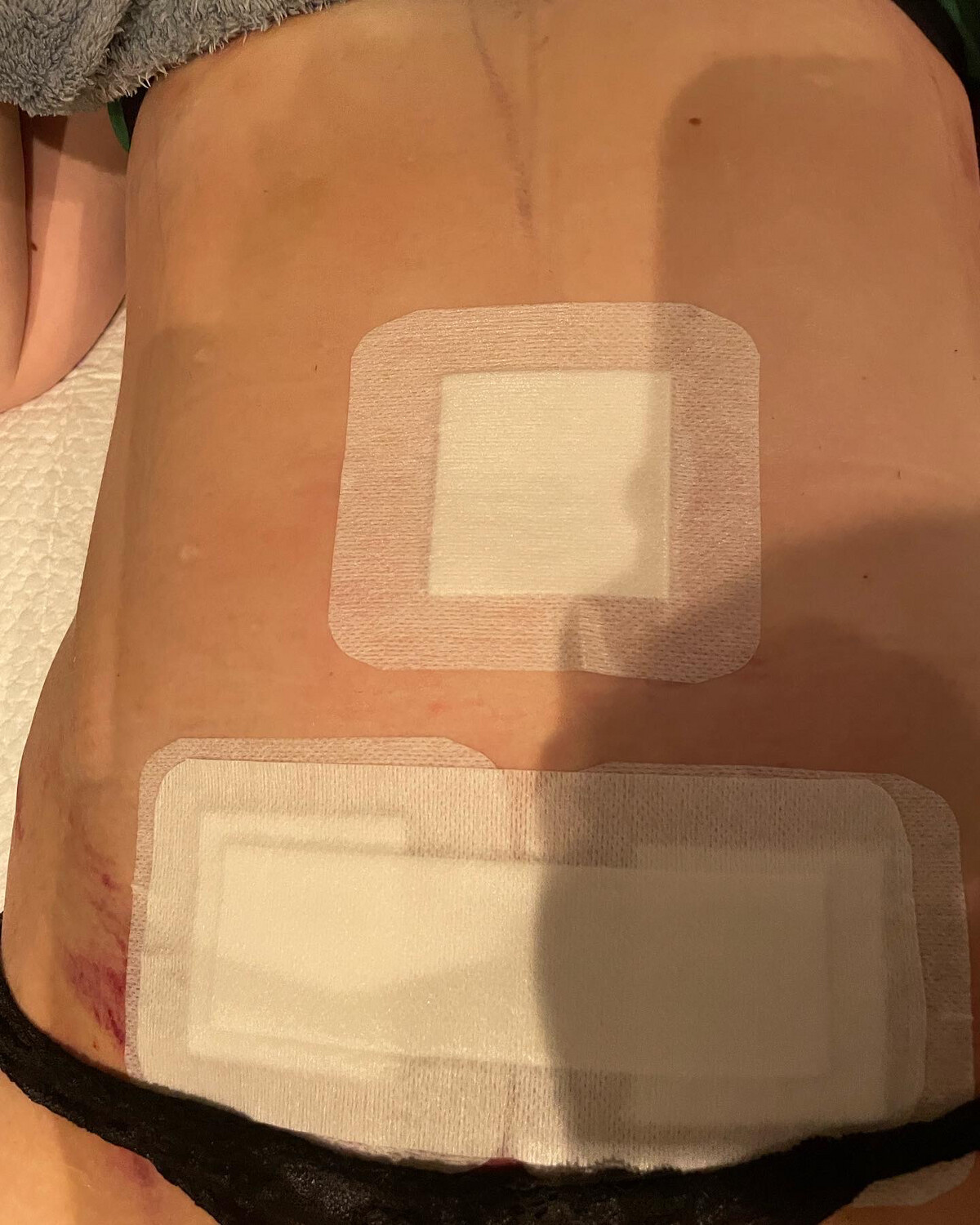 Postoperative lymphatic drainage