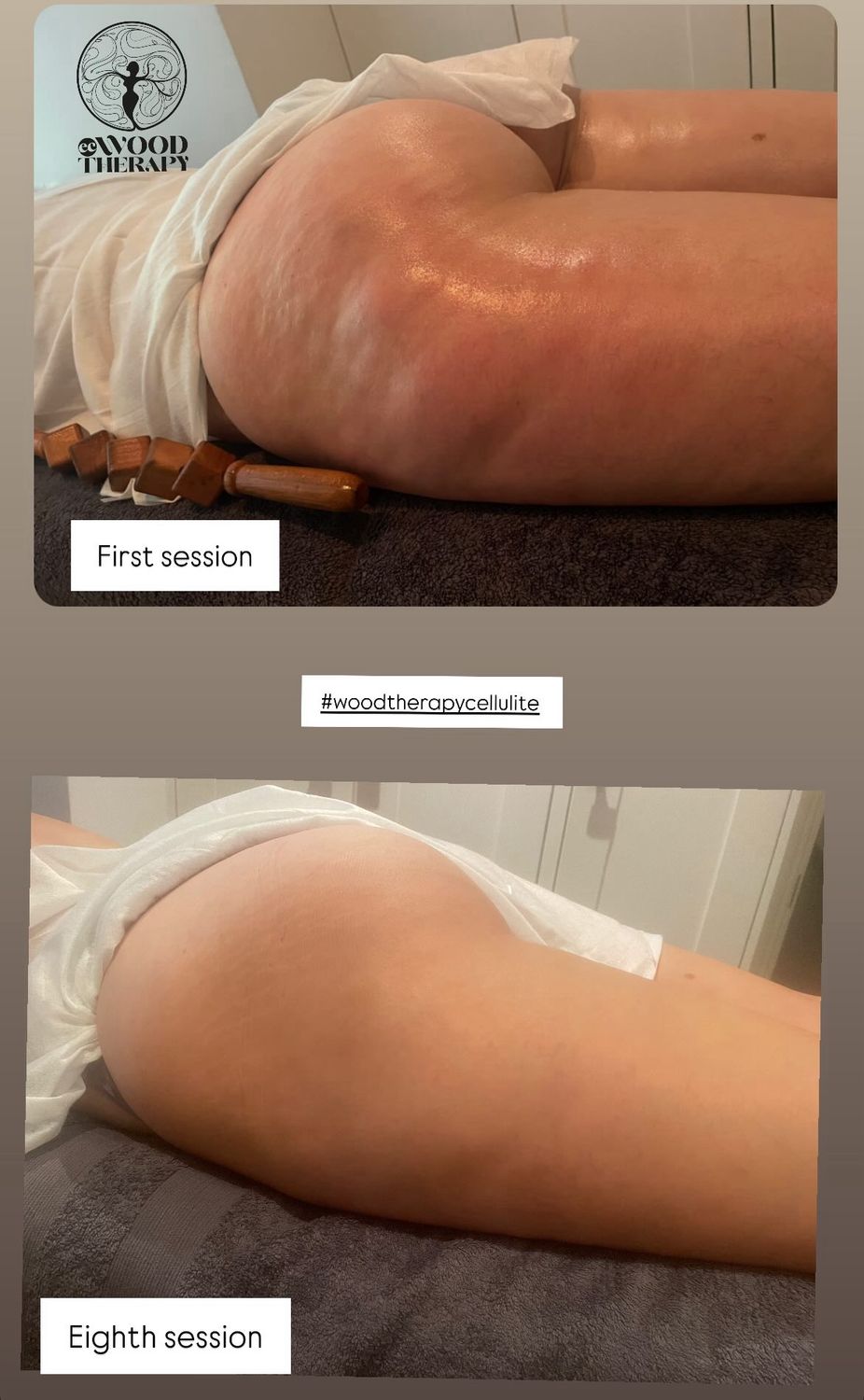 Treatment combining mesotherapy and wood therapy for cellulite