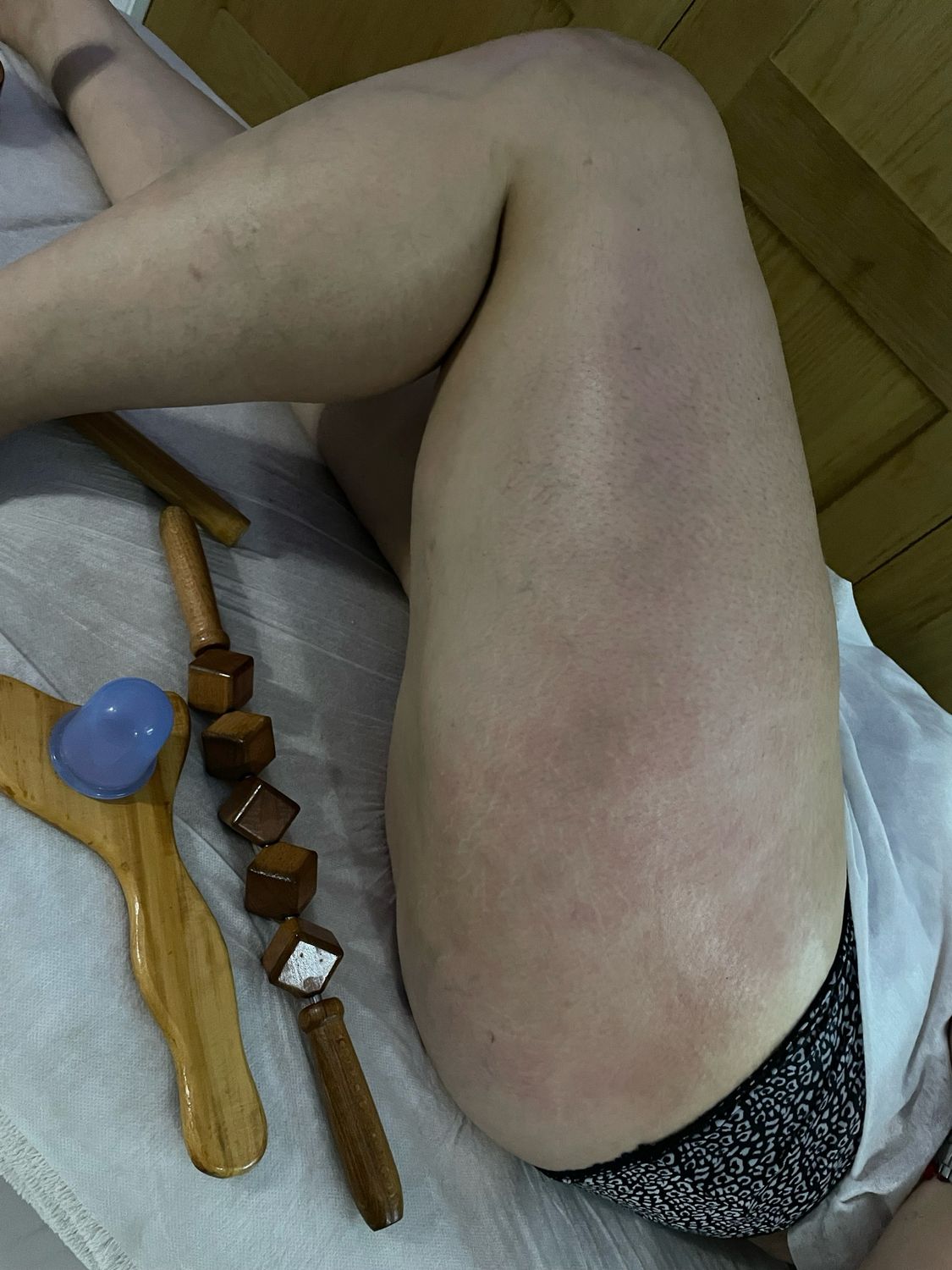 Treatment combining mesotherapy and wood therapy for cellulite