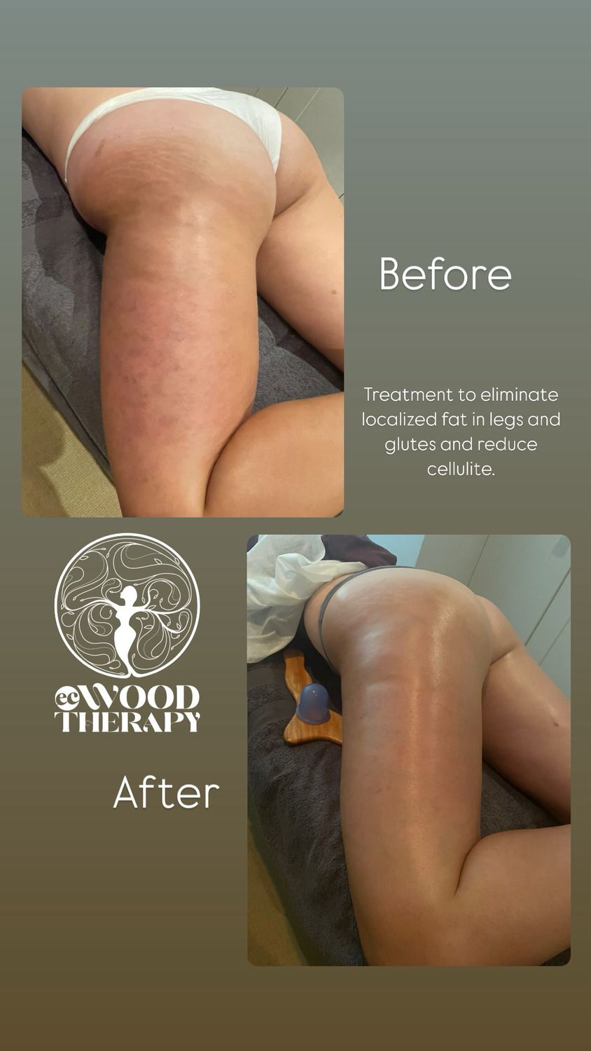 Treatment combining mesotherapy and wood therapy for cellulite